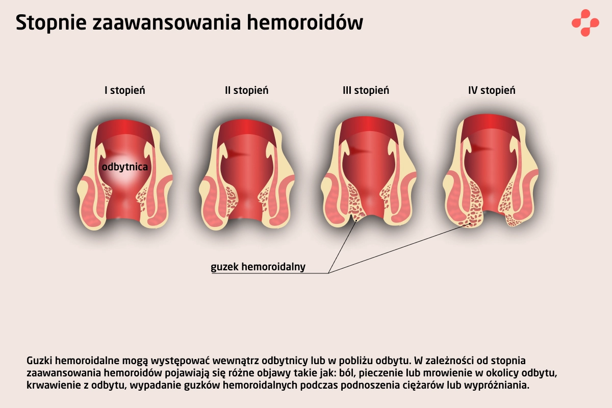 Sposoby Leczenia Hemoroidów W Różnych Stadiach — Blog Centrum Medycznego Doctorpro 4847