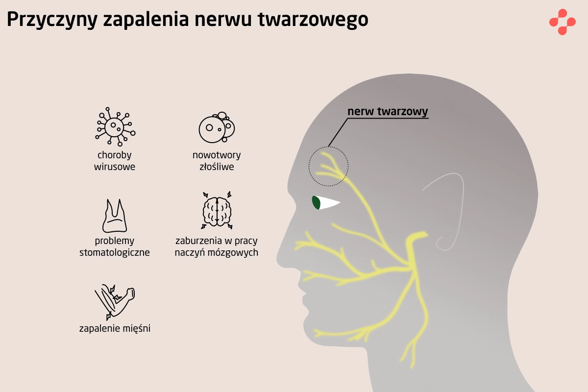 Przyczyny zapalenia nerwu twarzowego