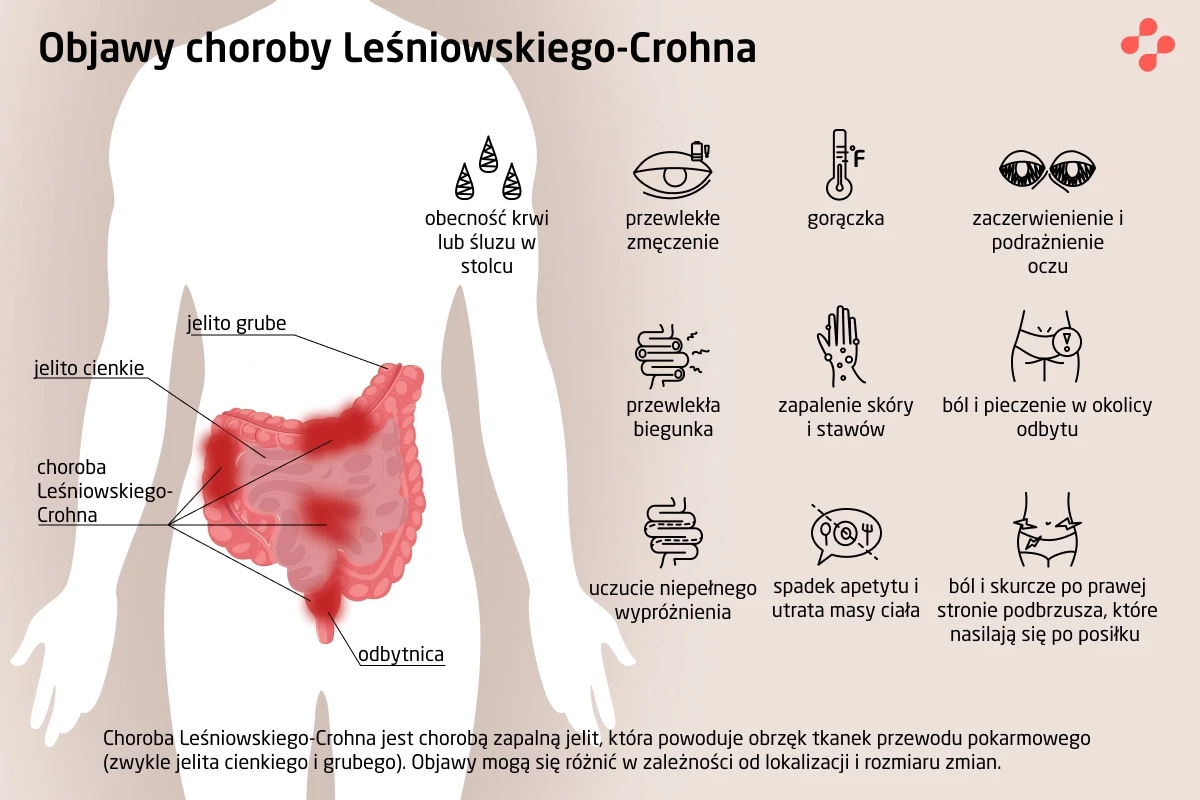 Objawy choroby Leśniowskiego-Crohna