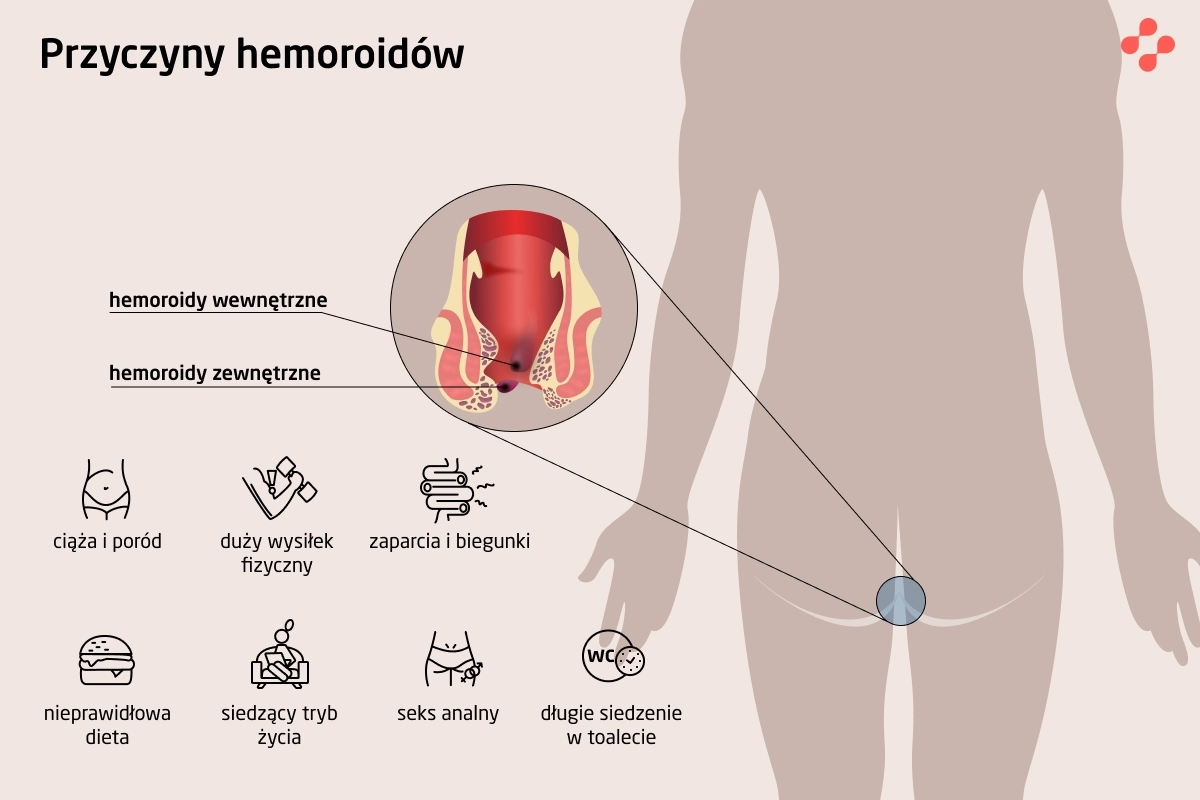 Przyczyny powstawania hemoroidów
