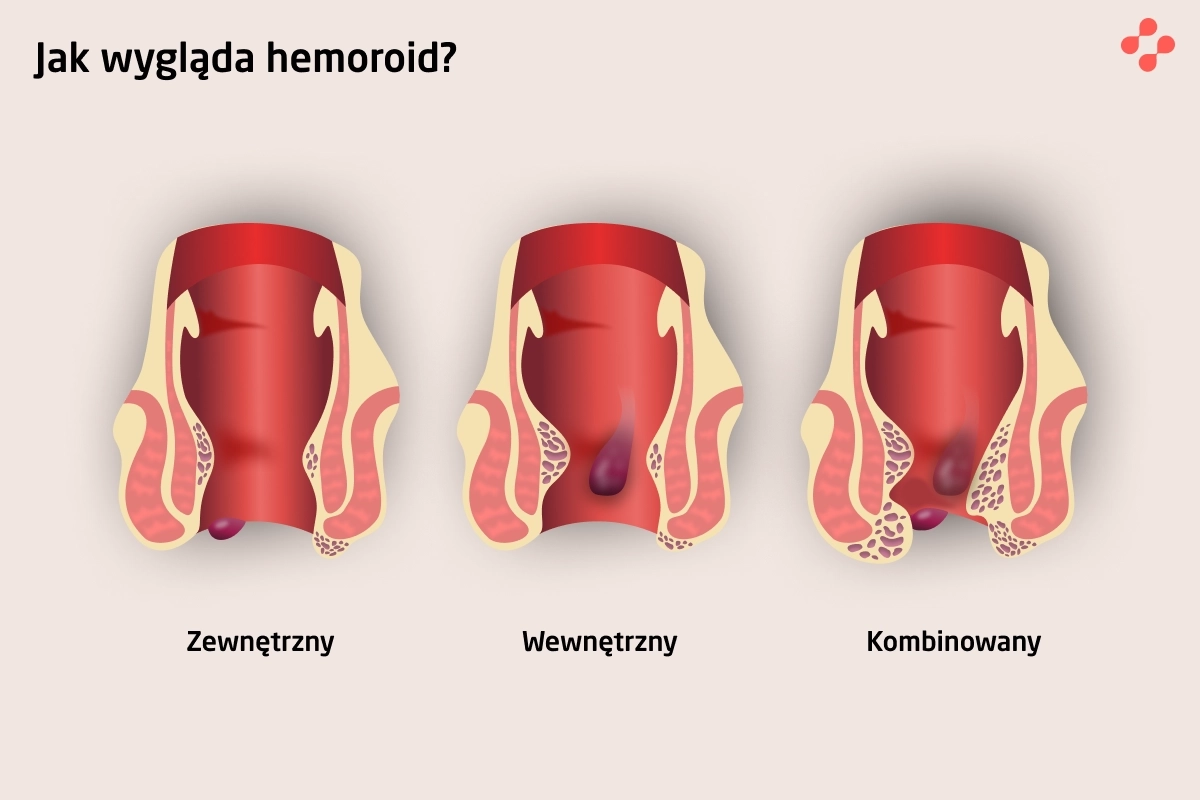 Jak wyglądają hemoroidy?
