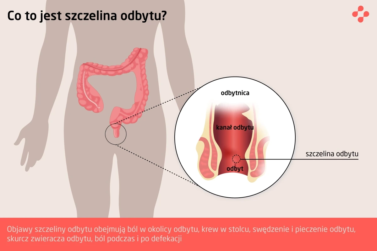 Co to jest szczelina odbytu?