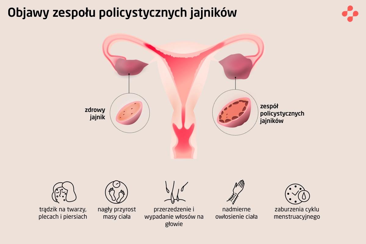 Objawy I Leczenie Zespołu Policystycznych Jajników Pcos — Blog Centrum Medycznego Doctorpro 9035