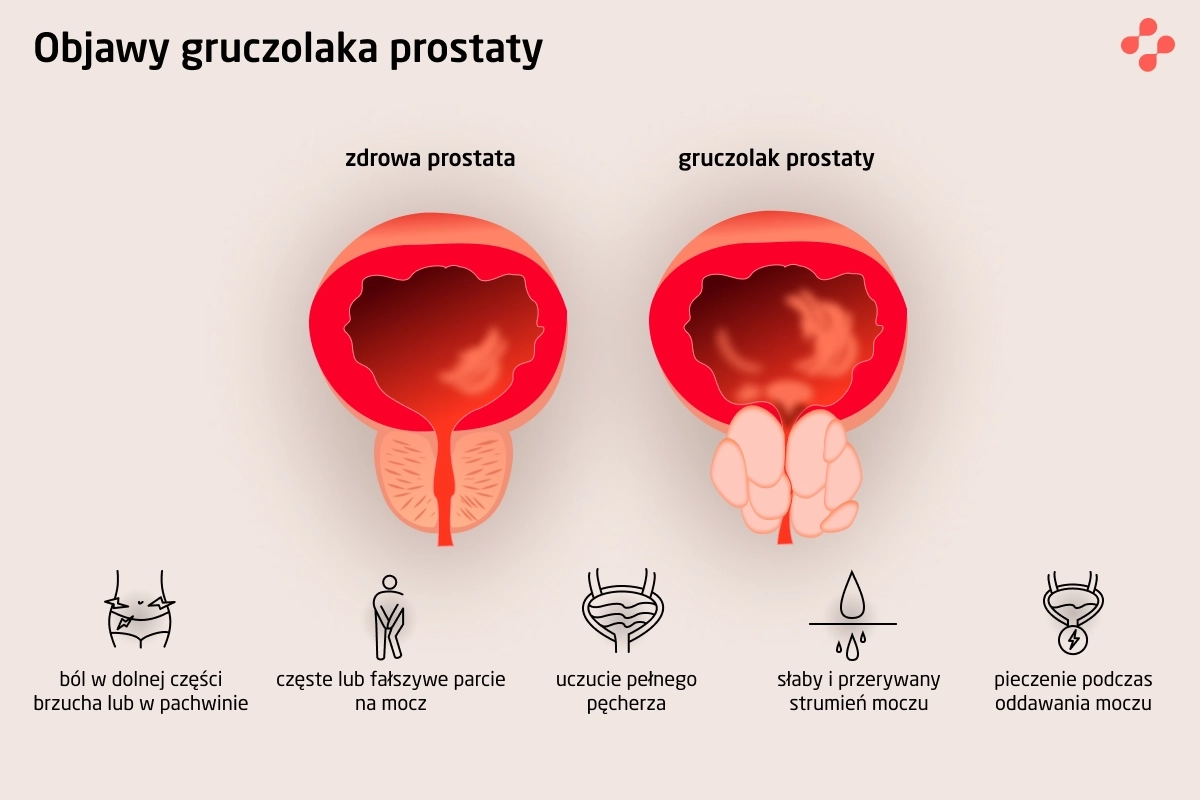 Objawy gruczolaka prostaty