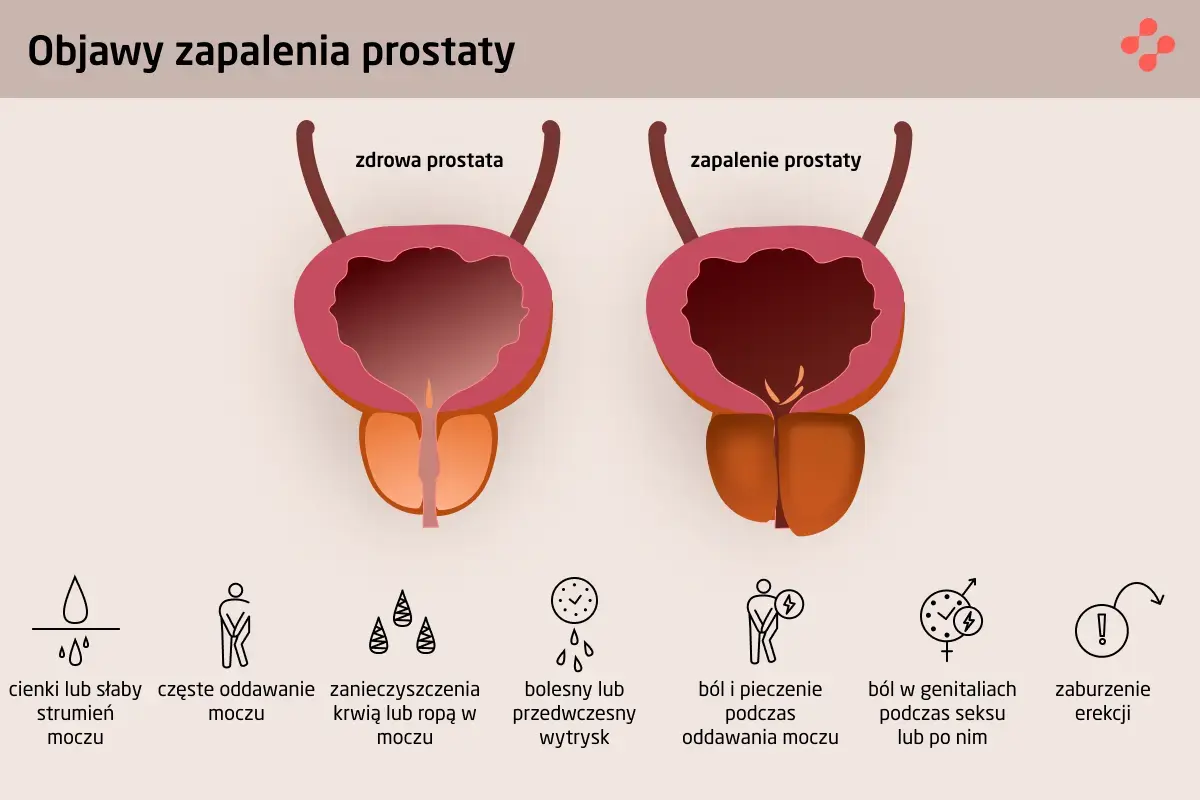 Objawy zapalenia gruczołu krokowego