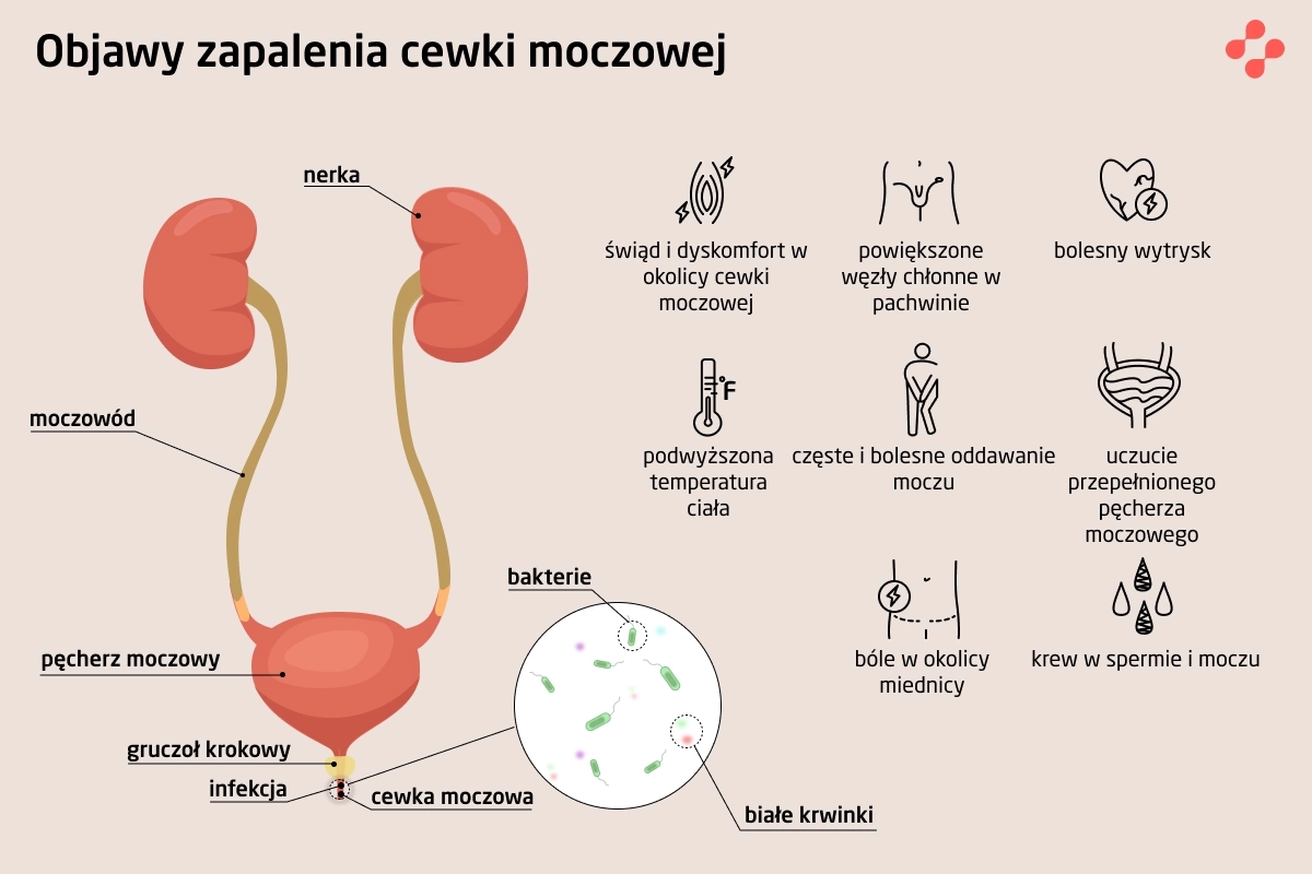 Objawy zapalenia cewki moczowej