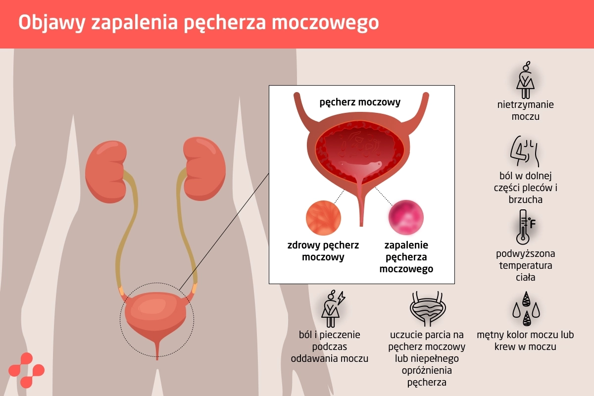 Objawy zapalenia pęcherza moczowego