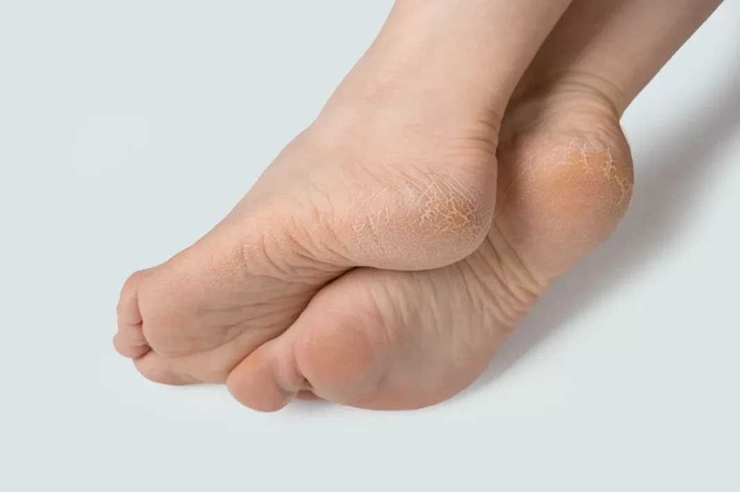 Keratodermia stóp