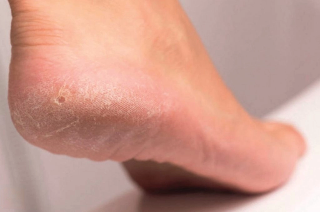 Keratodermia na pięcie