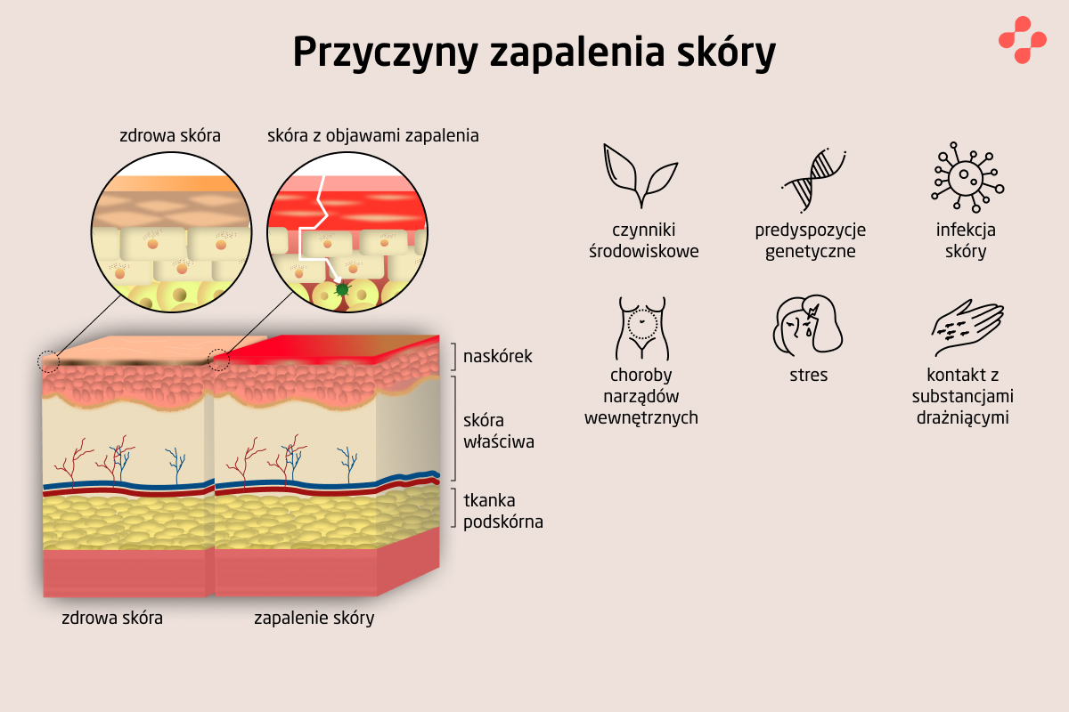 Przyczyny zapalenia skóry