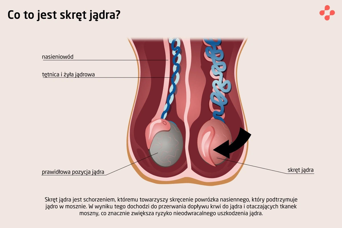 Co to jest skręt jądra?