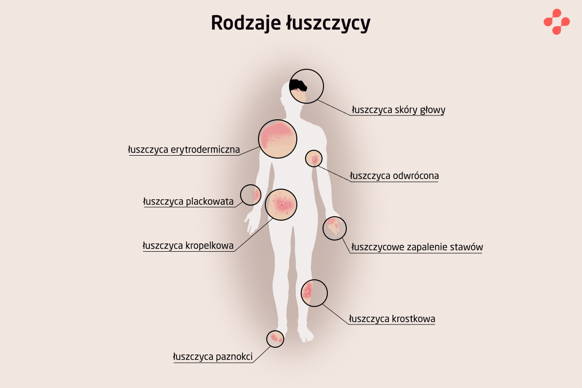 Jakie są rodzaje łuszczycy