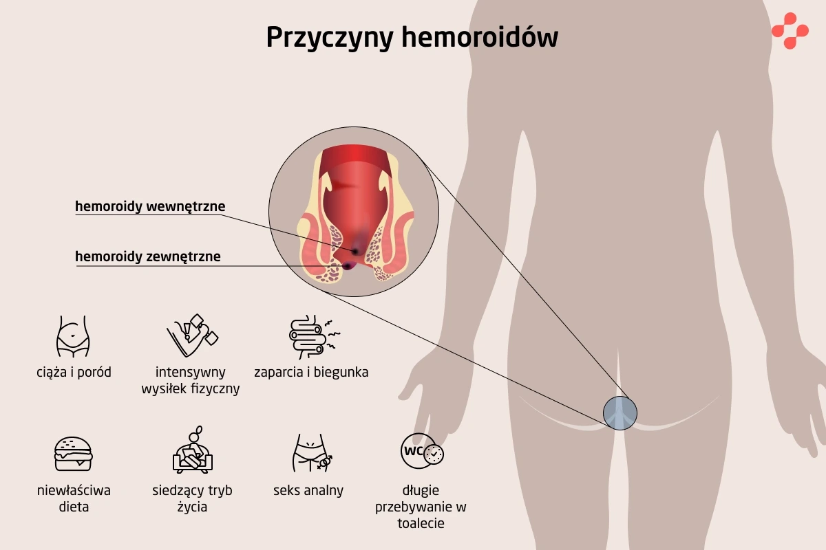 Jak powstają hemoroidy