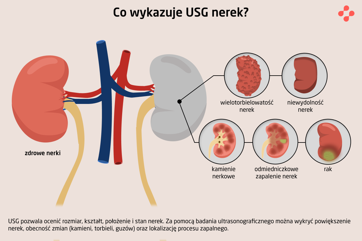 Co wykazuje USG nerek?