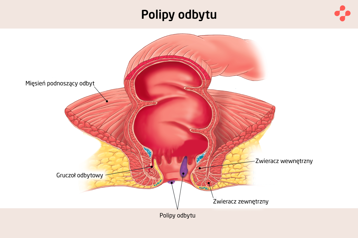 Wygląd i lokalizacja polipów odbytu