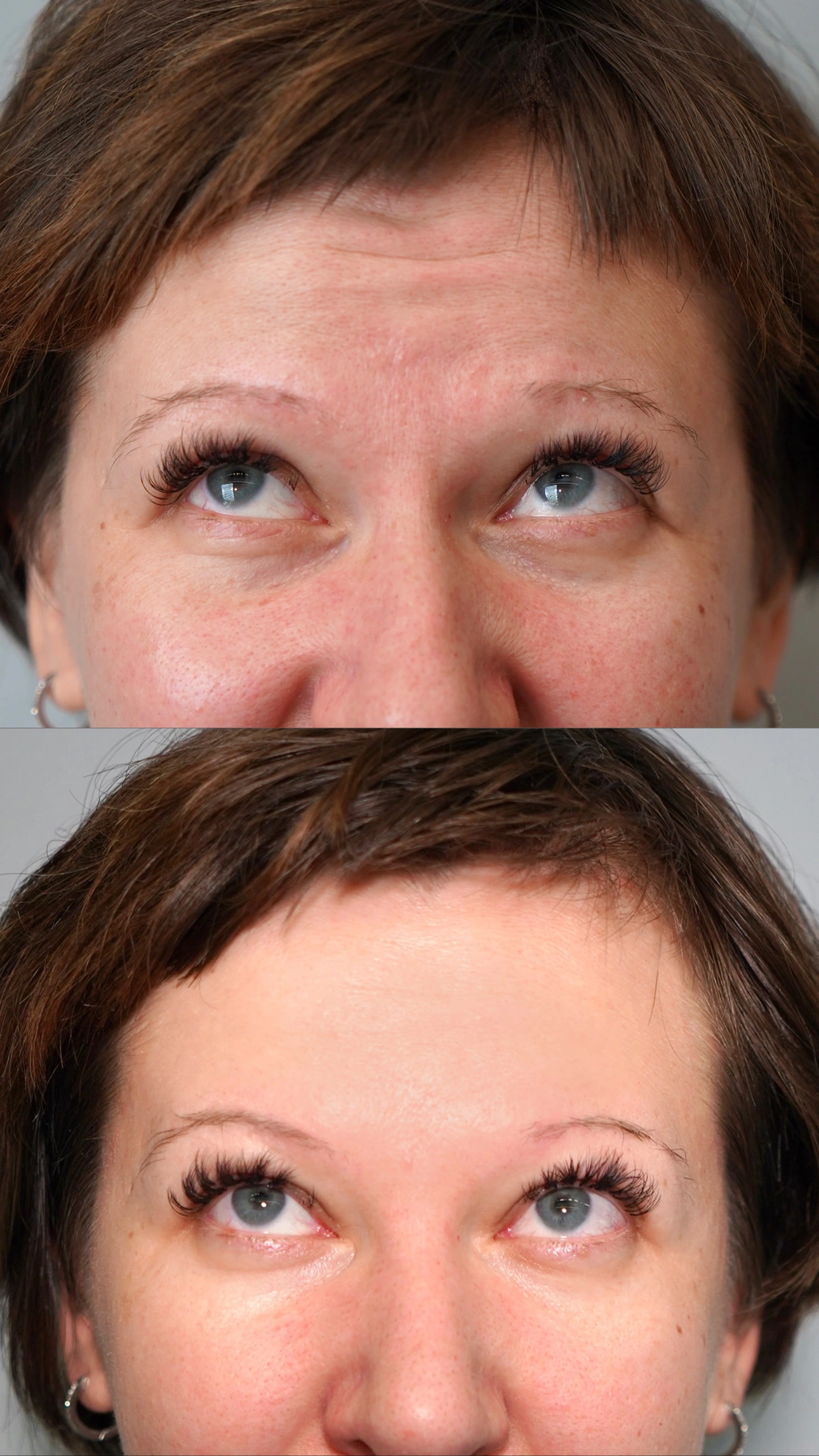 Efekty zabiegu botoksu na czoło