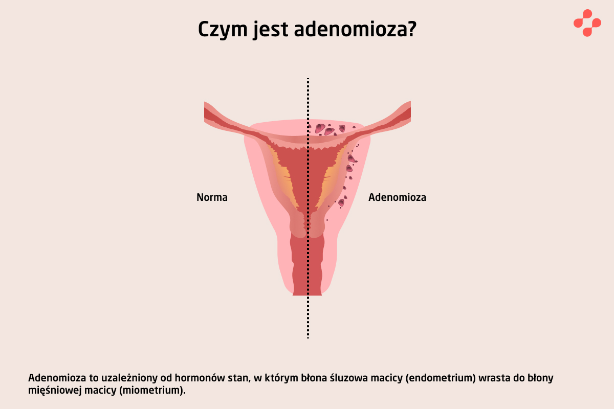 Czym jest adenomioza?