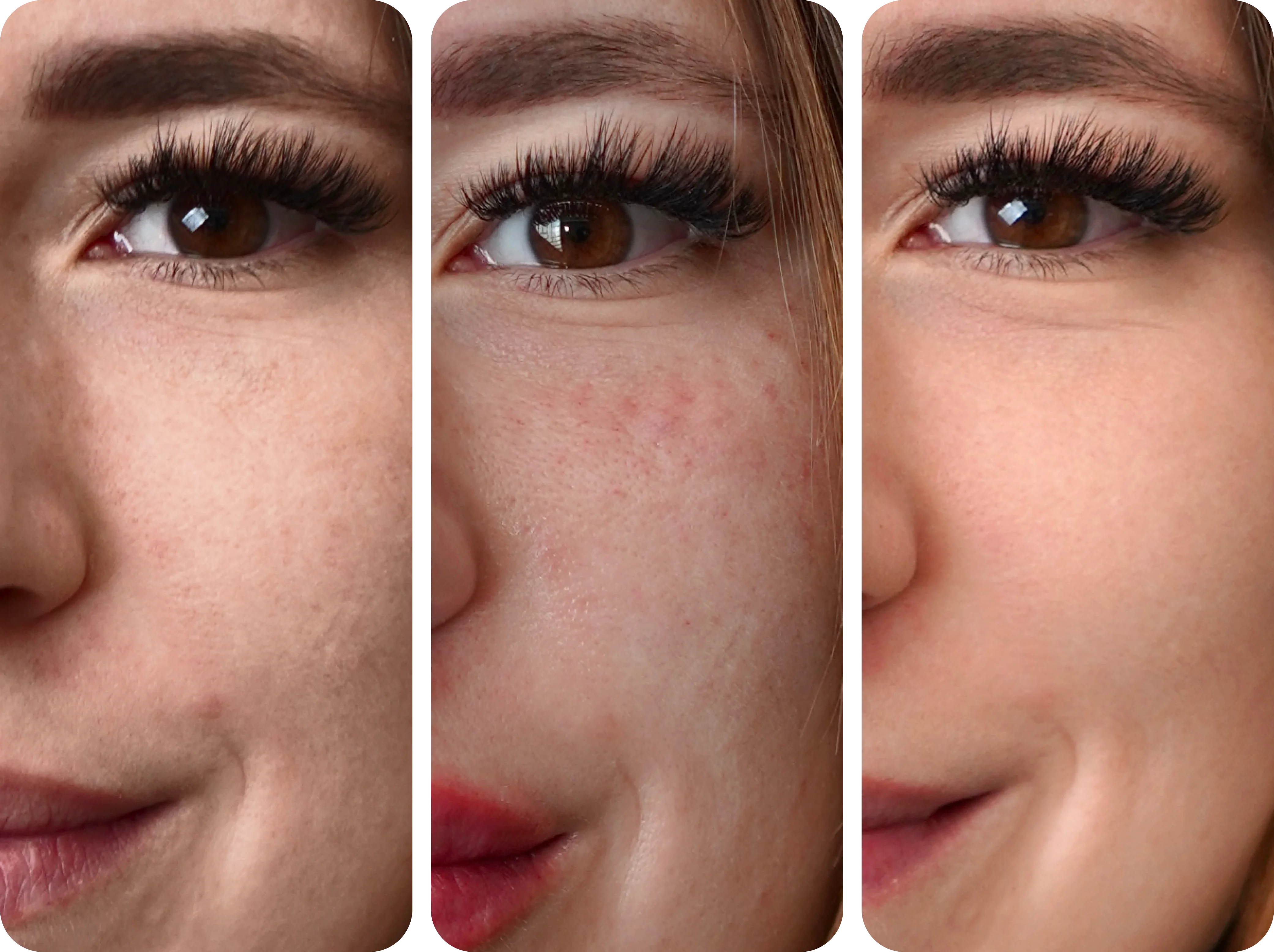 Efekty biorewitalizacji twarzy