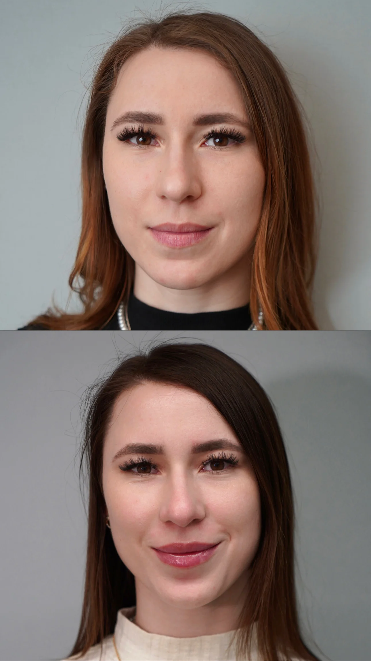 Modelowanie ust kwasem hialuronowym