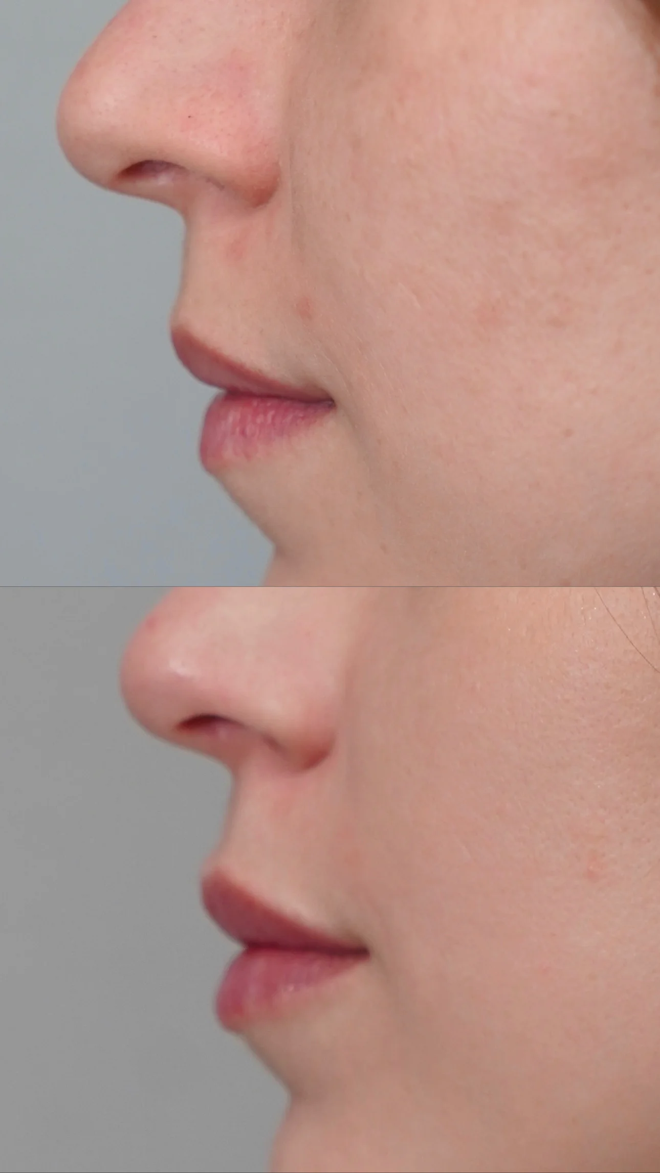 Efekt podania kwasu hialuronowego