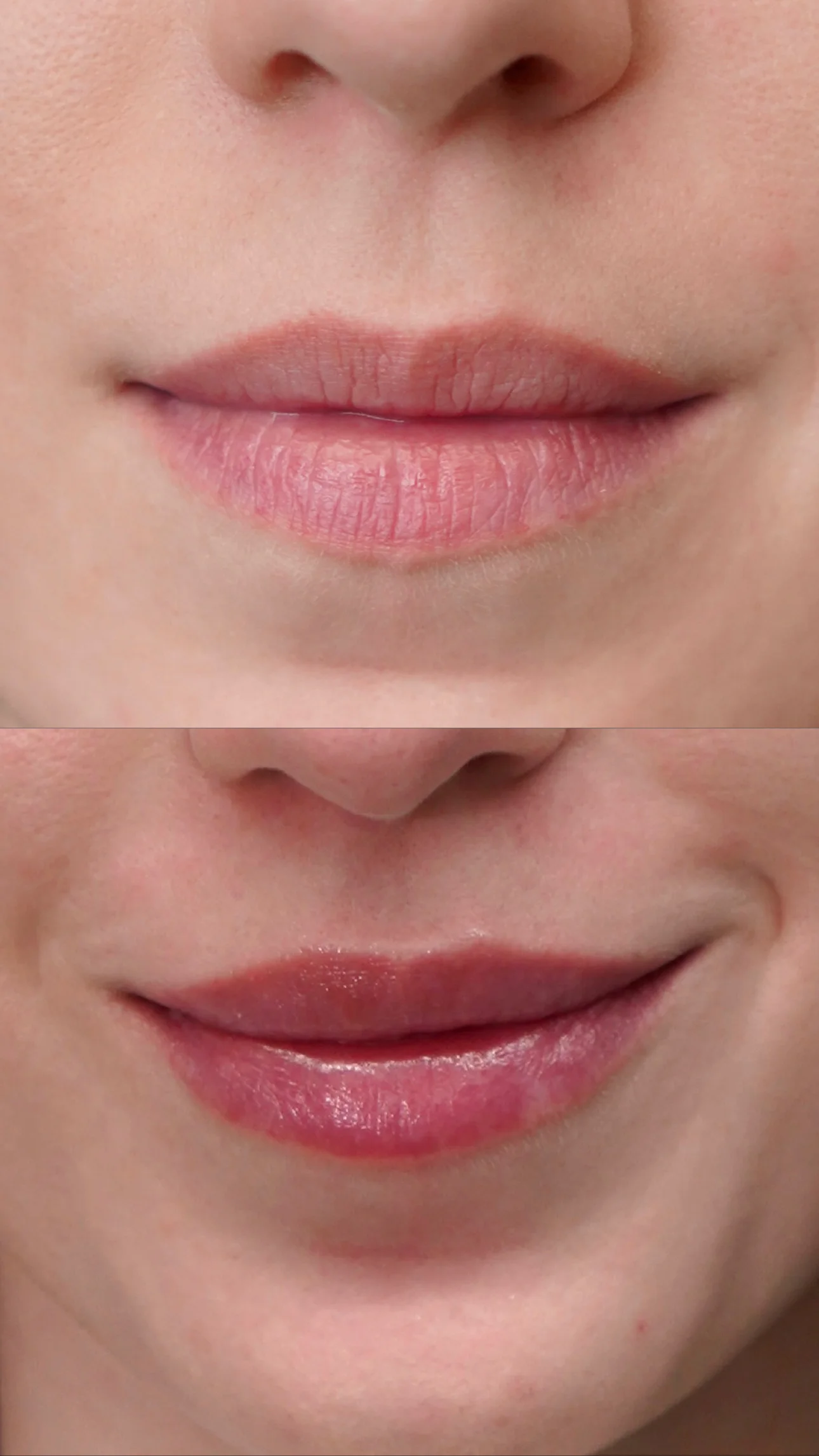 Efekty modelowania ust kwasem hialuronowym