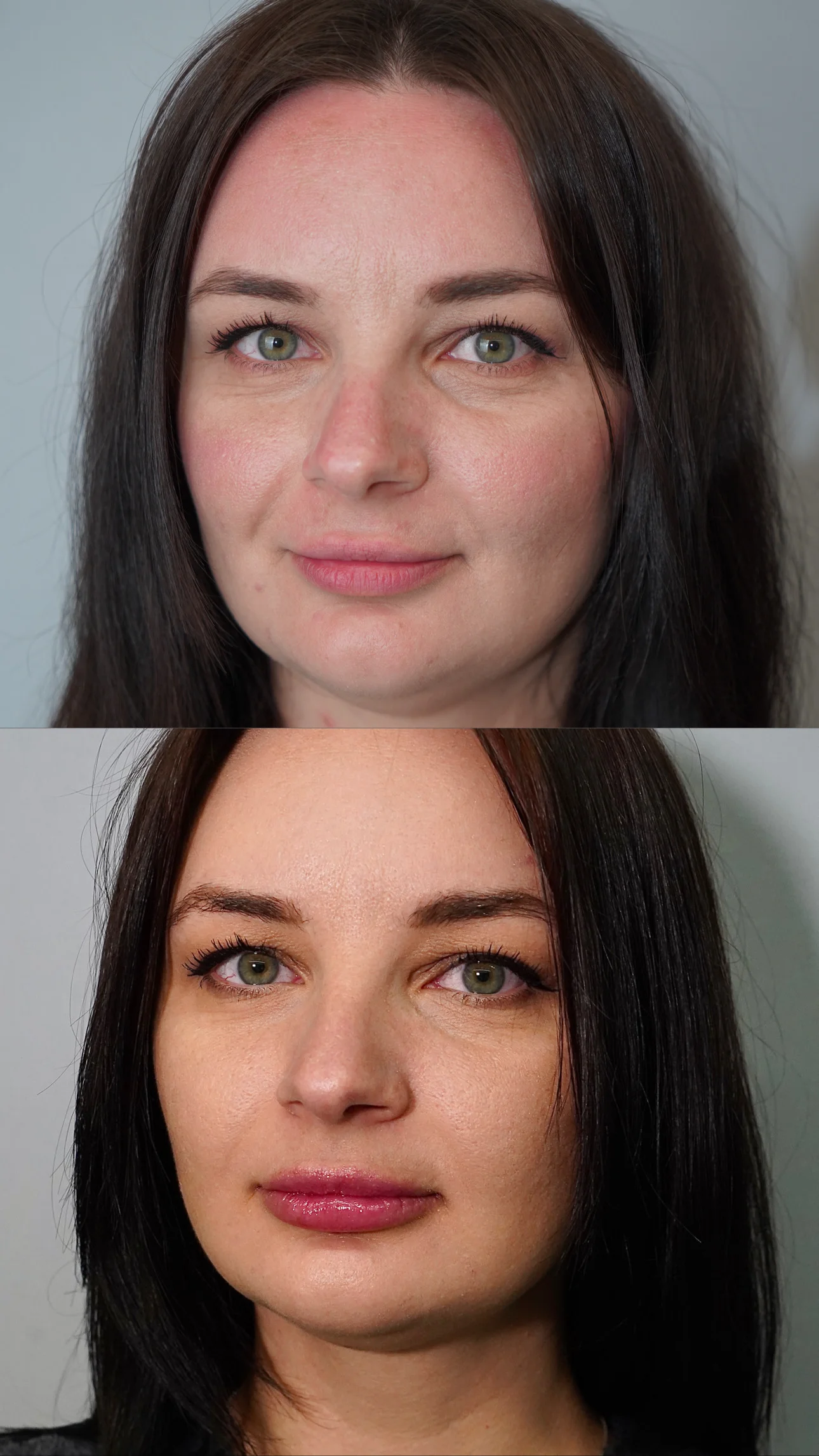 Efekty powiększania ust kwasem hialuronowym