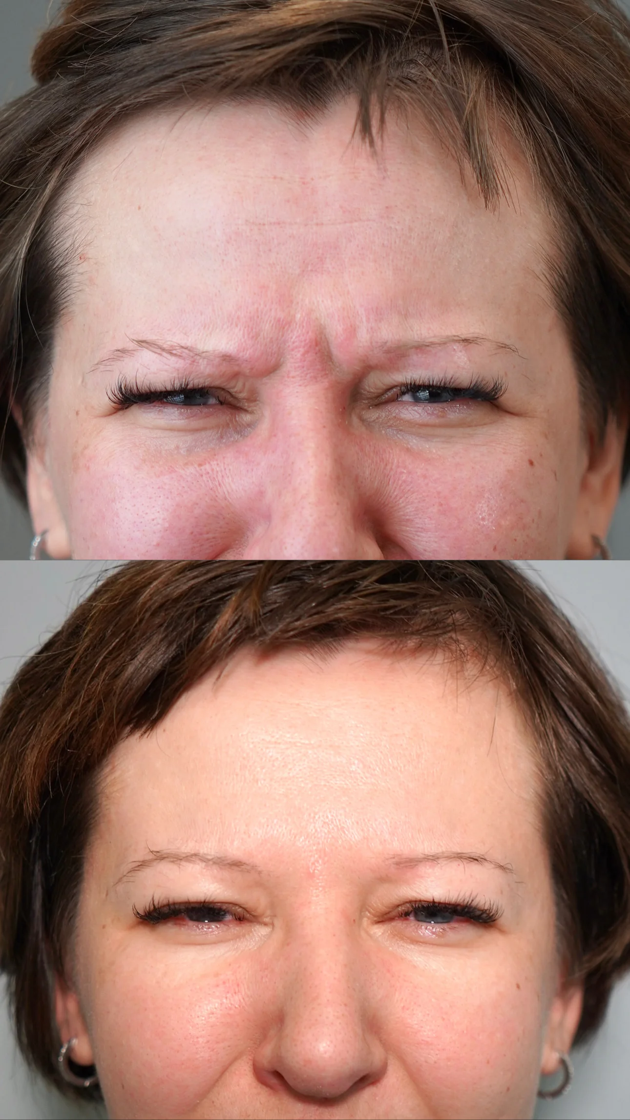 Toksyna botulinowa w Łodzi