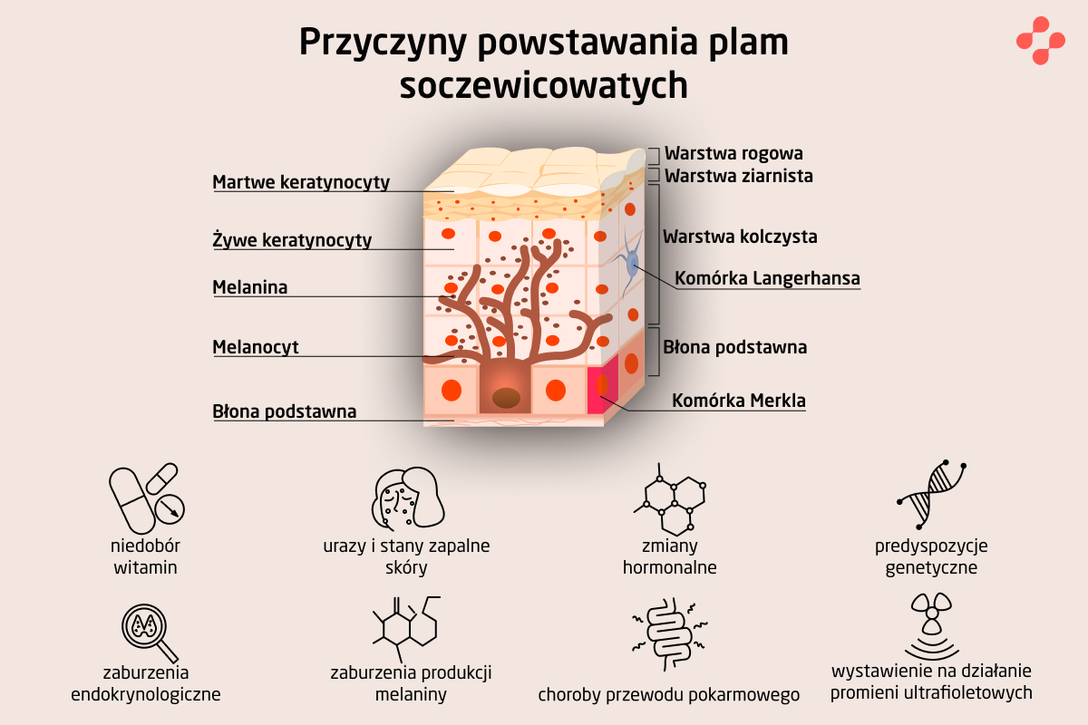 Jak powstają plamy soczewicowate