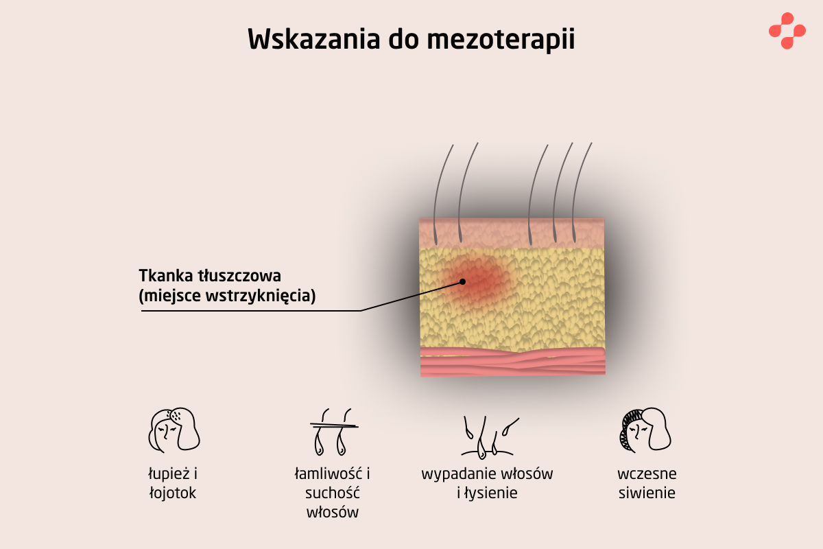 Wskazania do mezoterapii