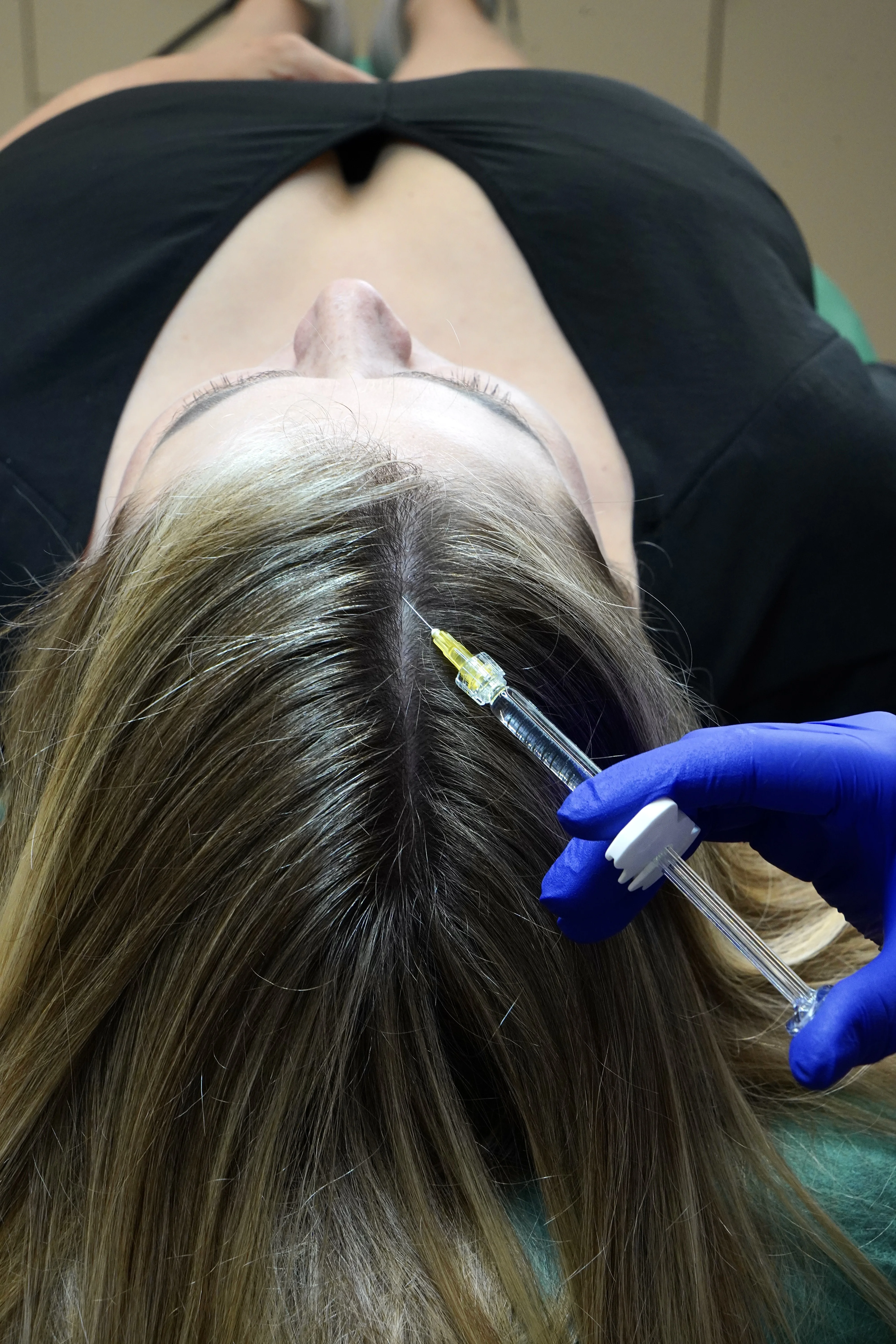 Mezoterapia igłowa skóry głowy