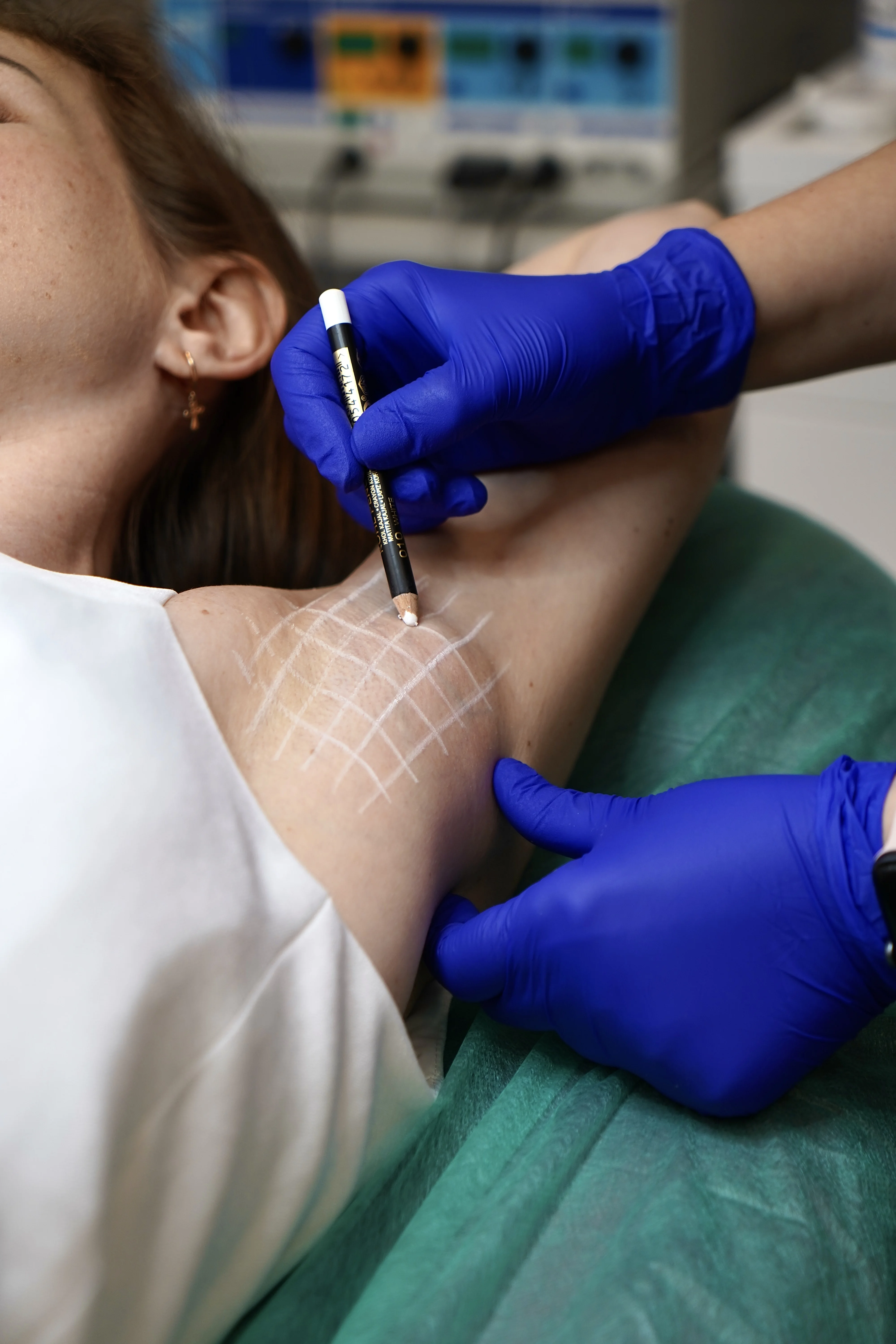 Toksyna botulinowa na nadmierną potliwość