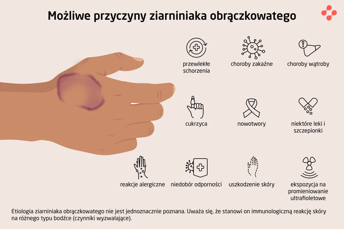 Możliwe przyczyny ziarniniaka obrączkowatego