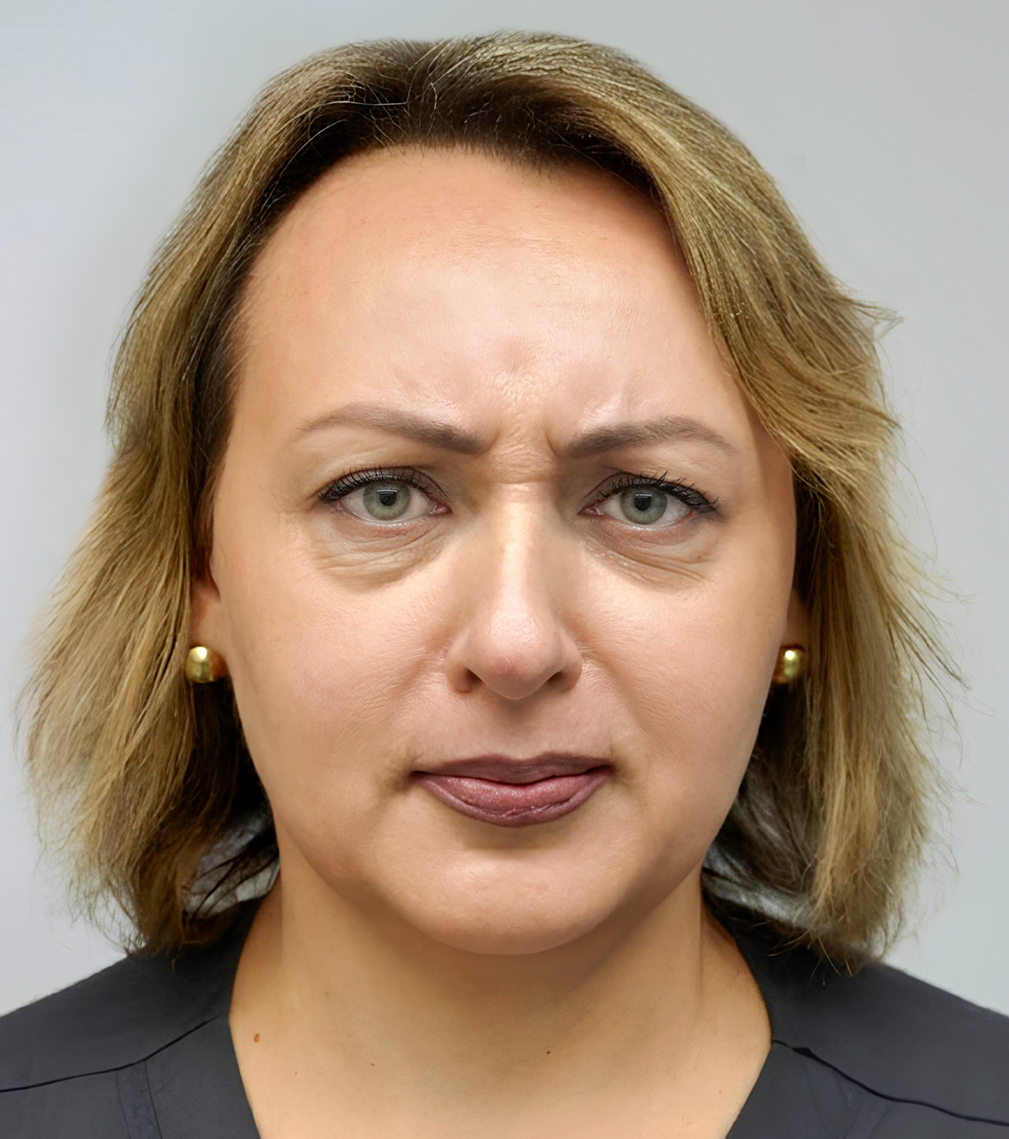 Botoks na czoło — zdjęcie przed i po