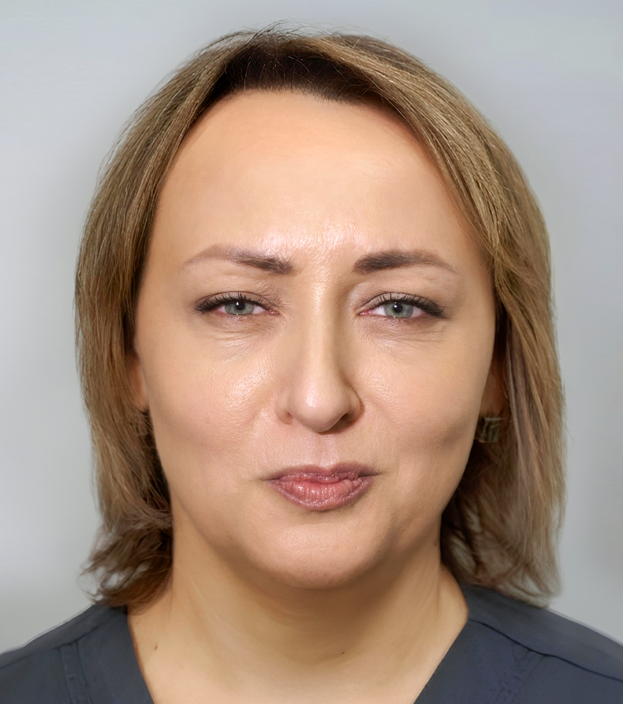 Botoks na czoło — zdjęcie przed i po