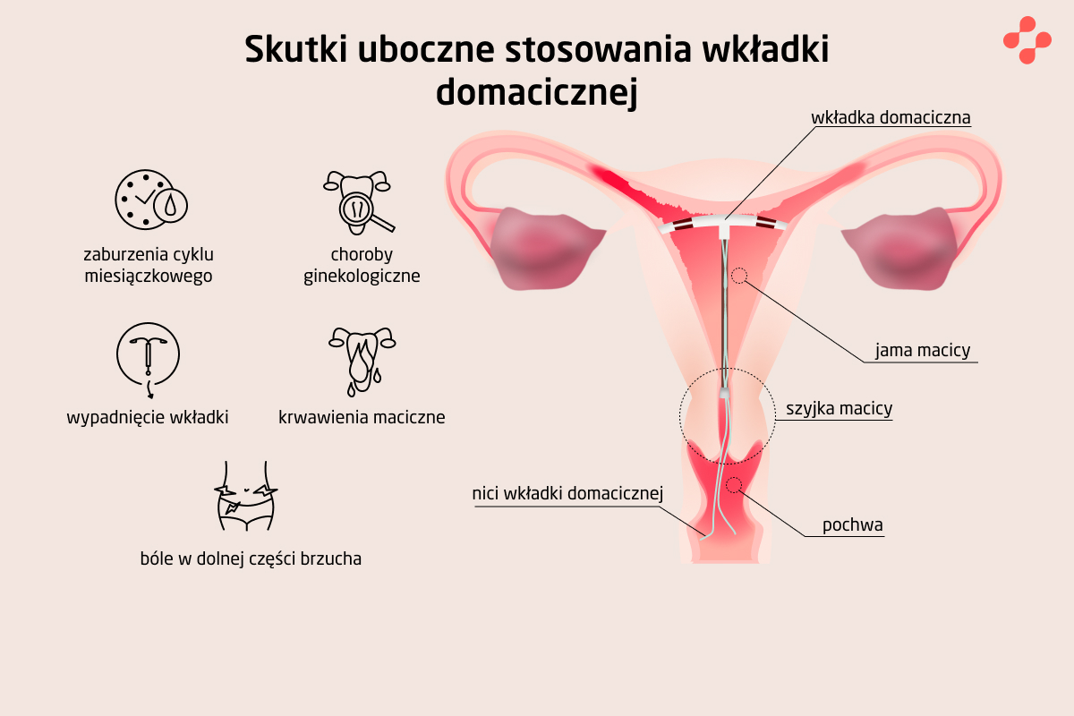 Powikłania wkładki domacicznej