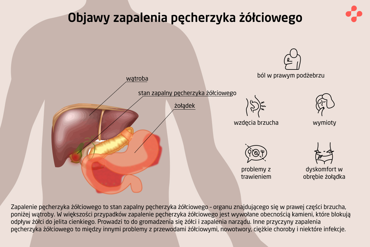 Objawy zapalenia pęcherzyka żółciowego