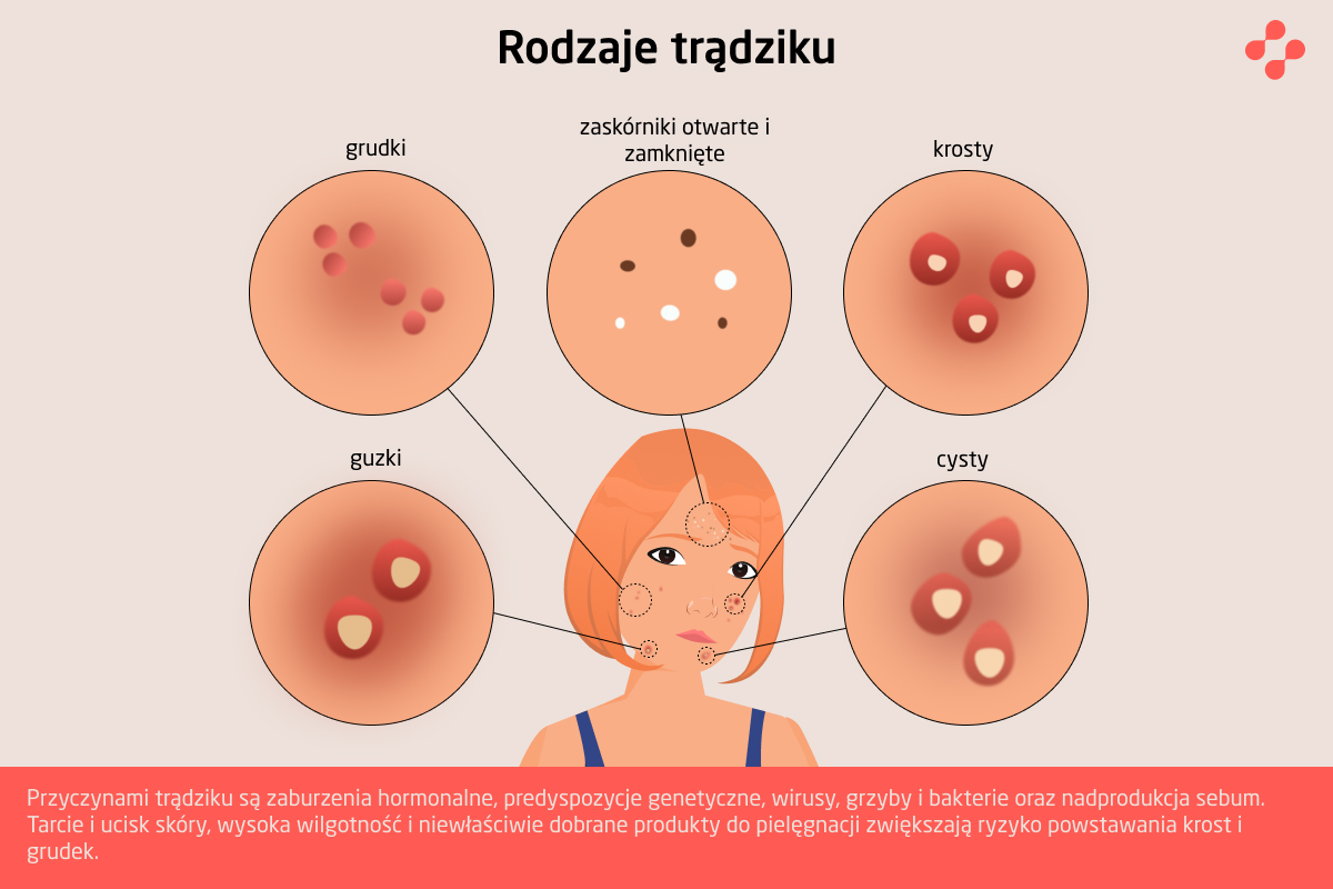 Rodzaje trądziku