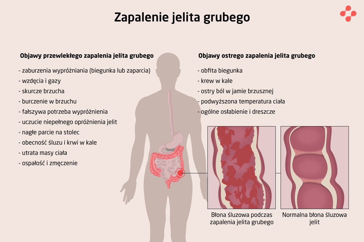 Objawy ostrego i przewlekłego zapalenia jelita grubego