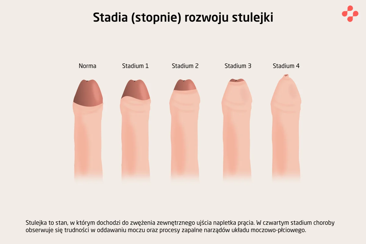 Etapy rozwoju stulejki