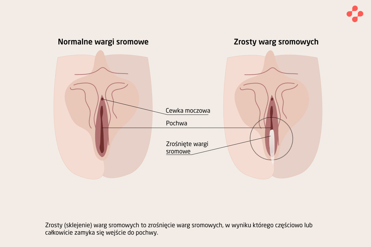 Zrost warg sromowych