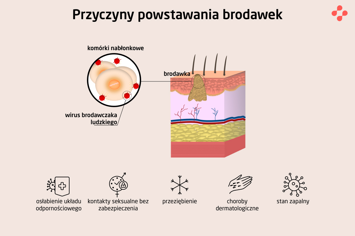 Przyczyny powstawania brodawek