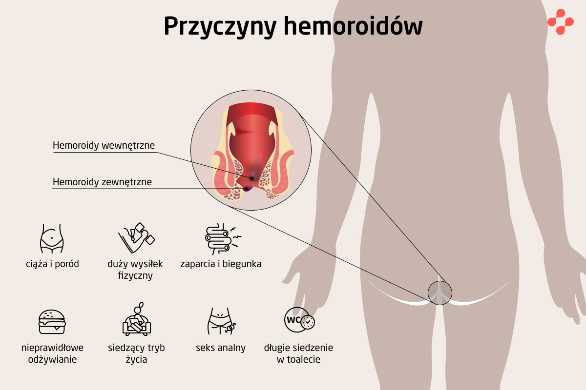 Jakie są przyczyny hemoroidów wewnętrznych?