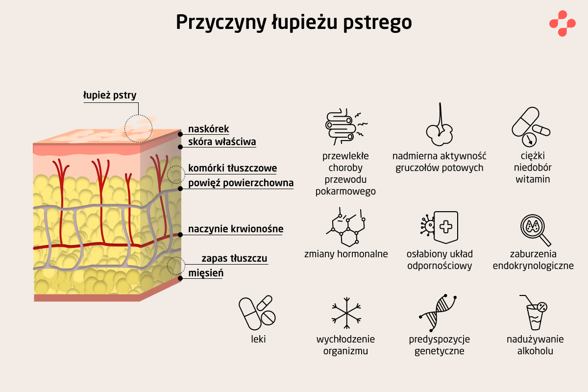 Dlaczego pojawia się łupież pstry?