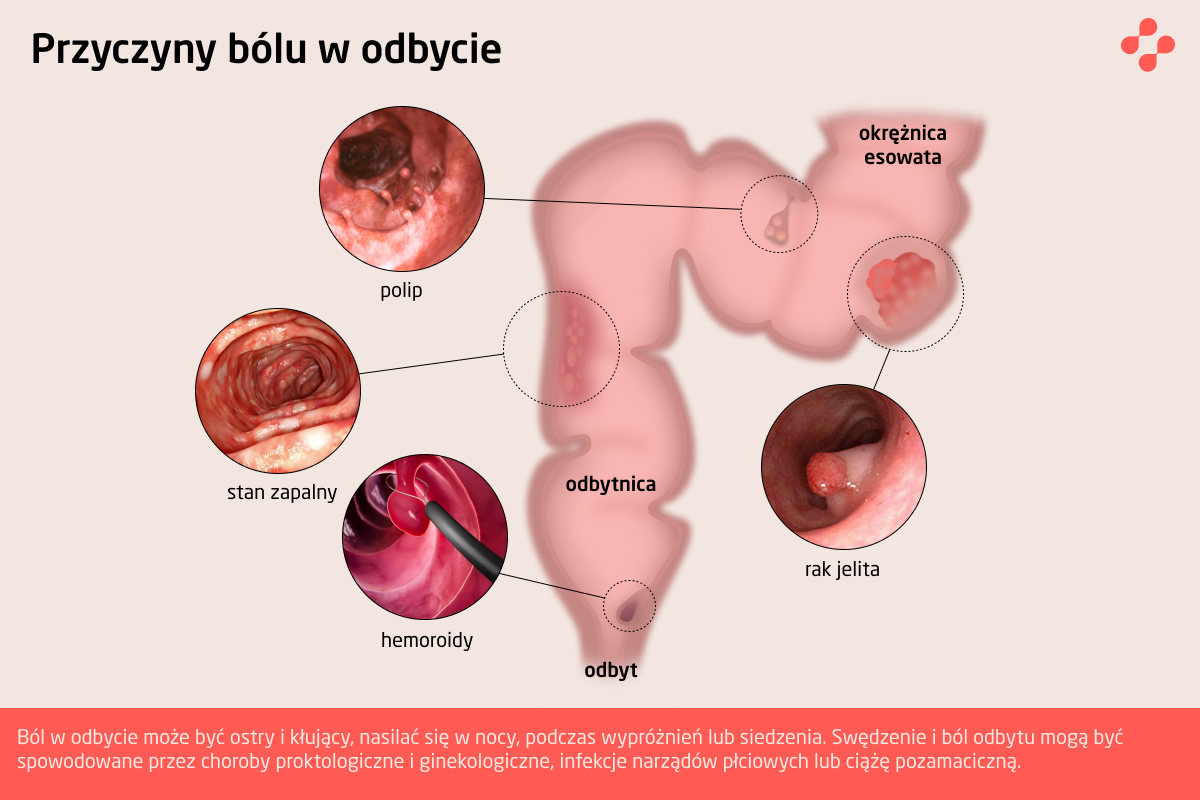 Przyczyny bólu odbytu