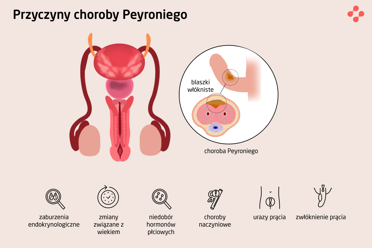 Przyczyny choroby Peyroniego