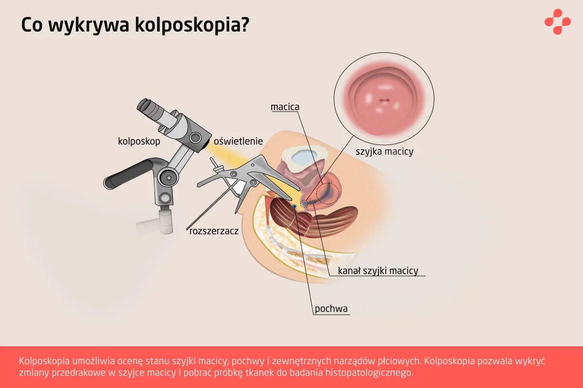 Co pokazuje kolposkopia