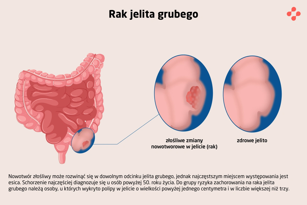 Czym jest rak jelita grubego