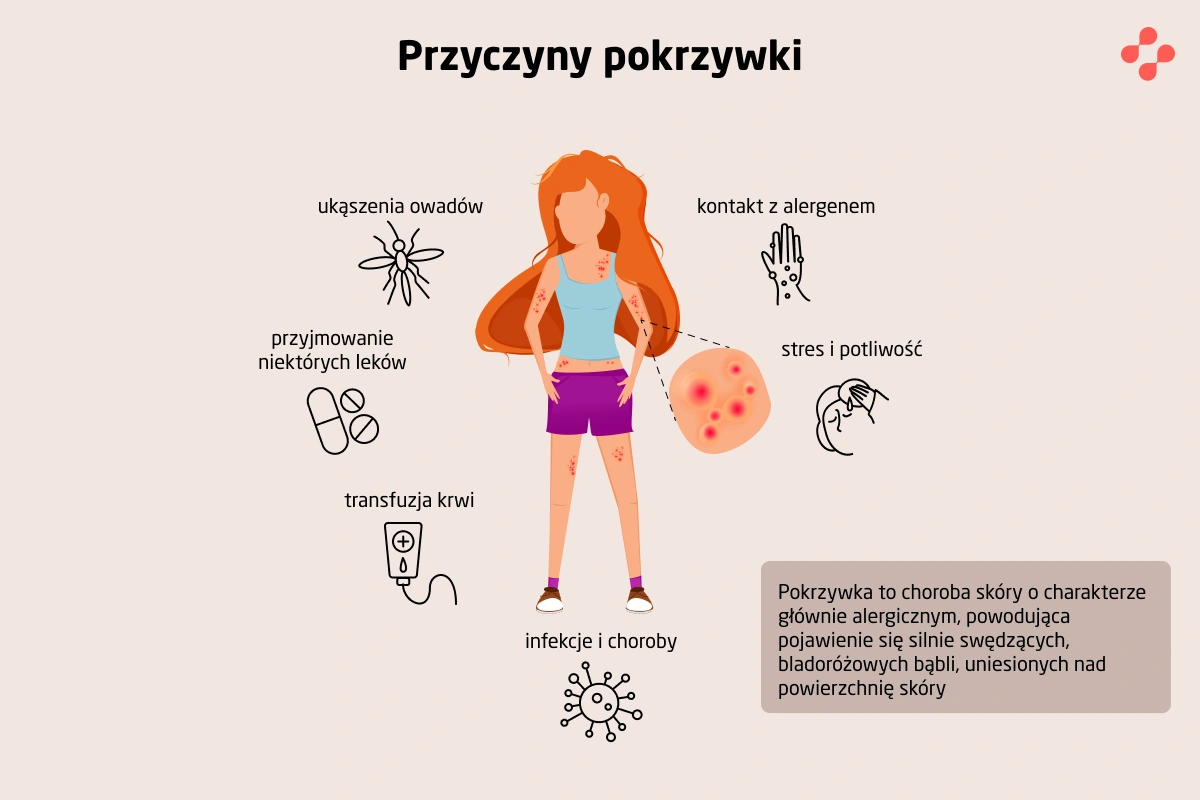 Przyczyny pokrzywki na skórze