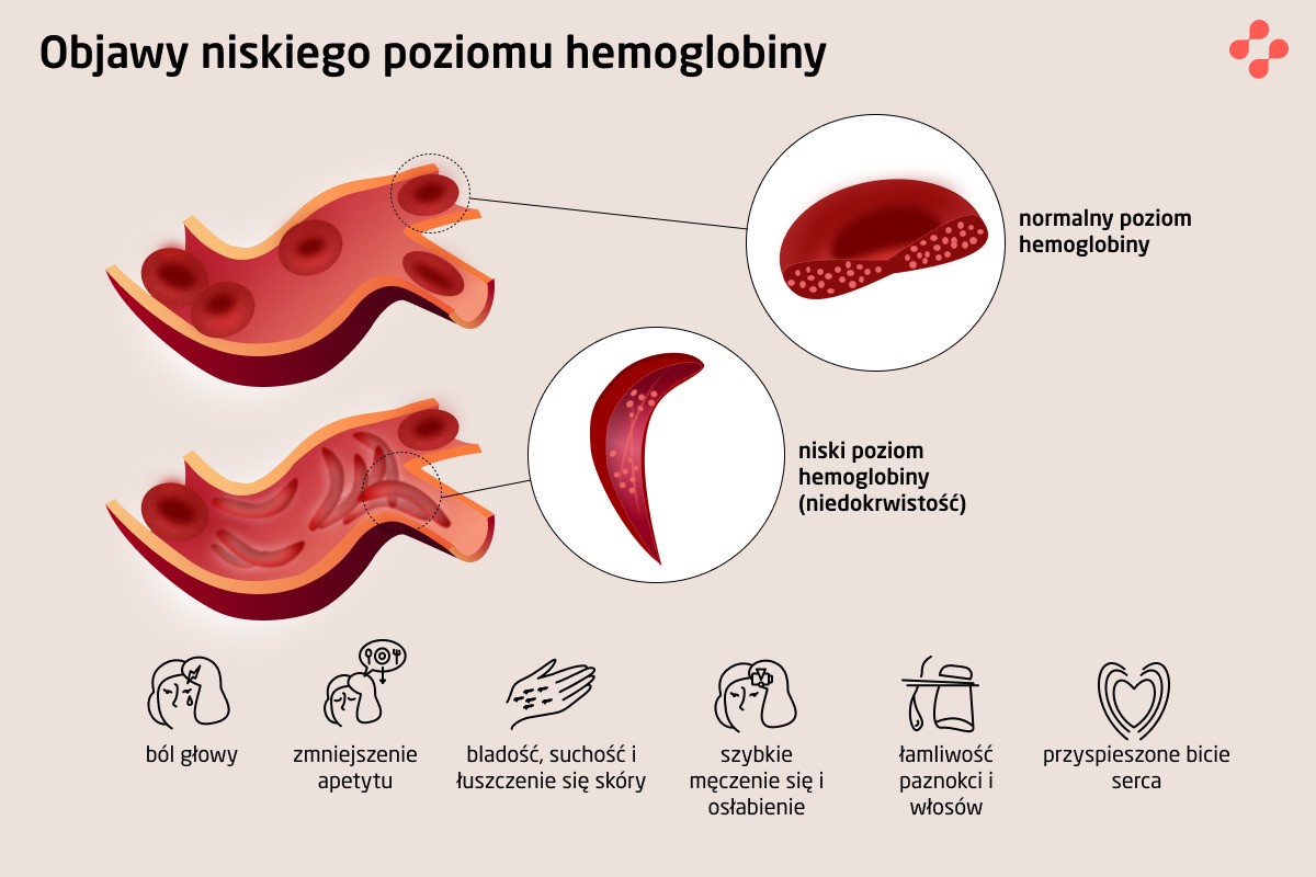Objawy niskiego poziomu hemoglobiny