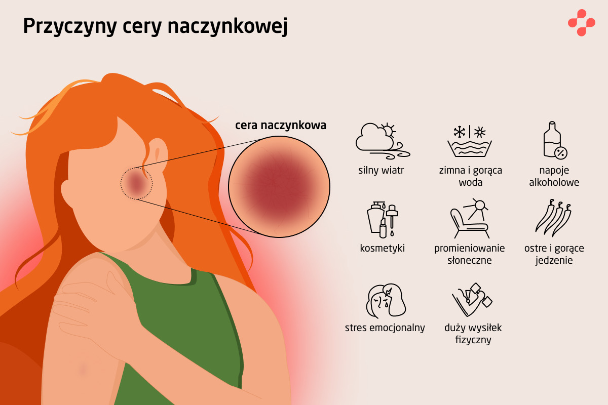 Przyczyny cery naczynkowej